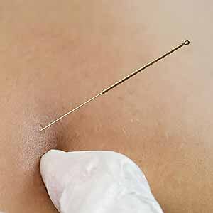 service_needling_nav-01 Dry Needling at Fitzgerald Physical Therapy